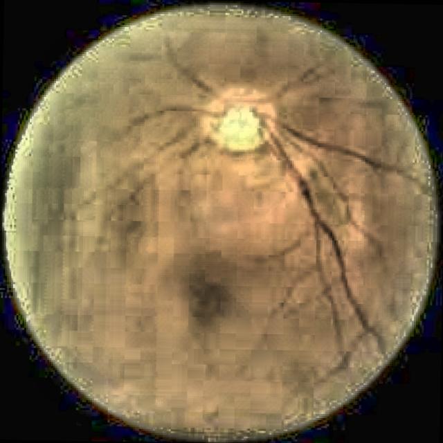 Preventing Vision Loss From Untreated Retinal Tears
