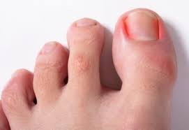The Impact of Ingrown Toenails on Foot Health