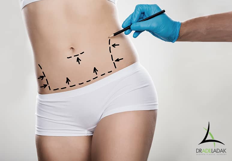 Five Questions to Ask During Your Tummy Tuck Consultation