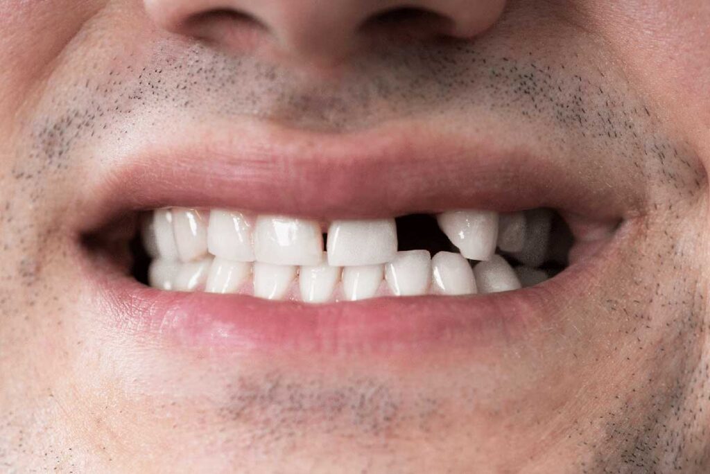 How to Choose Between Dental Implants and Other Tooth Replacement Options