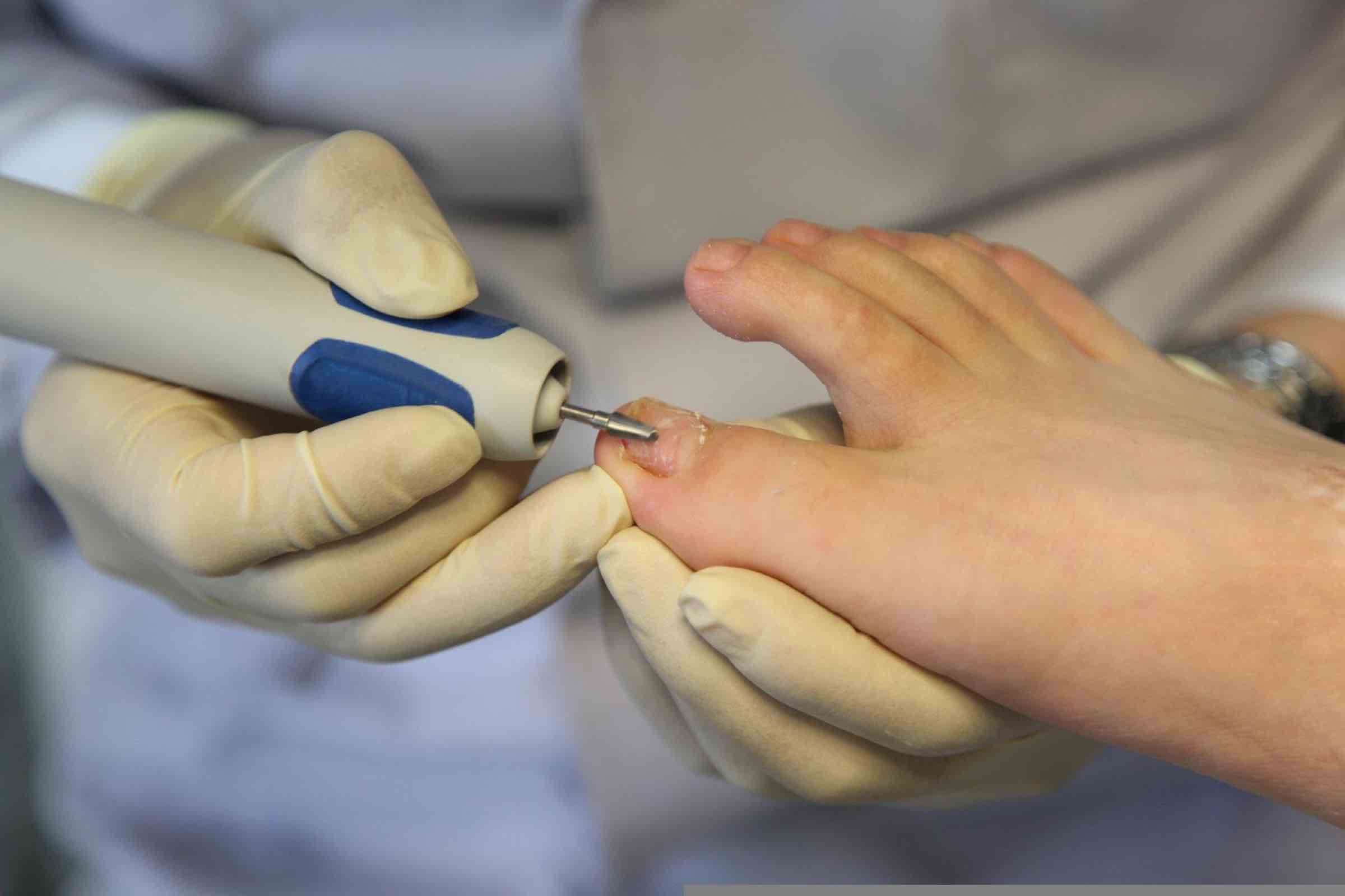 Ingrown Toenail Treatment: Professional and Home Care Options