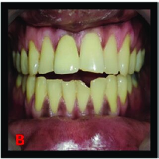 Questions and Concerns About Pediatric Root Canals