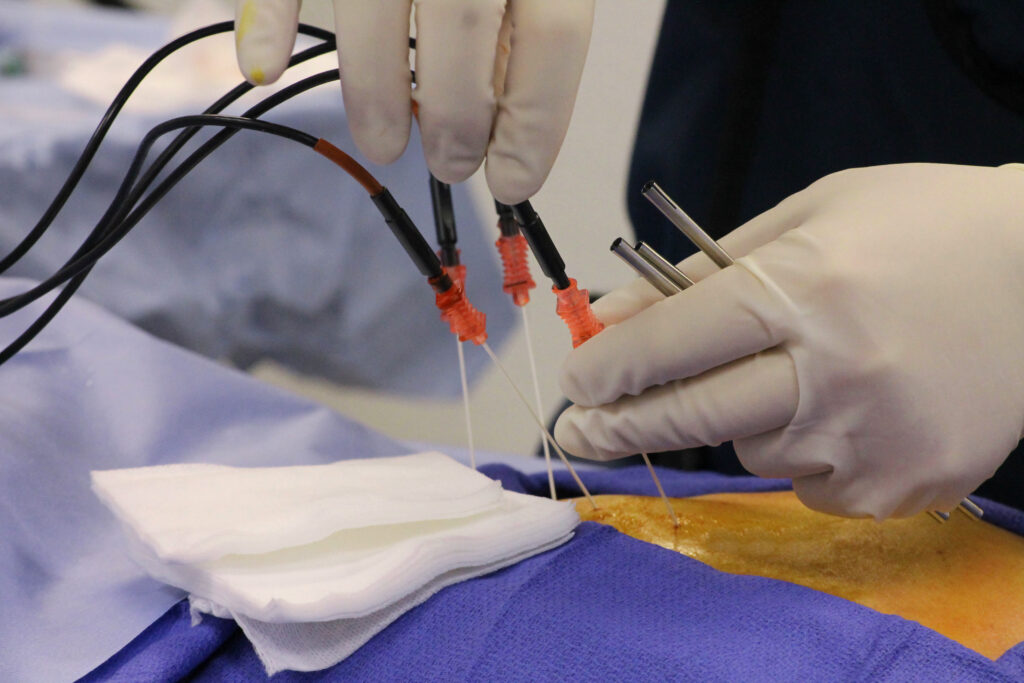 Radio Frequency Ablation for Pain Relief