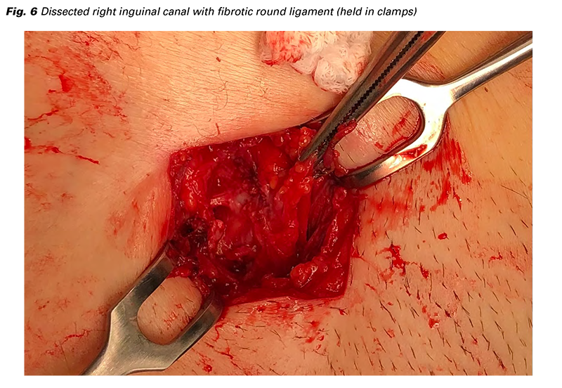 The Intersection of Gynecology and Endometriosis Treatment