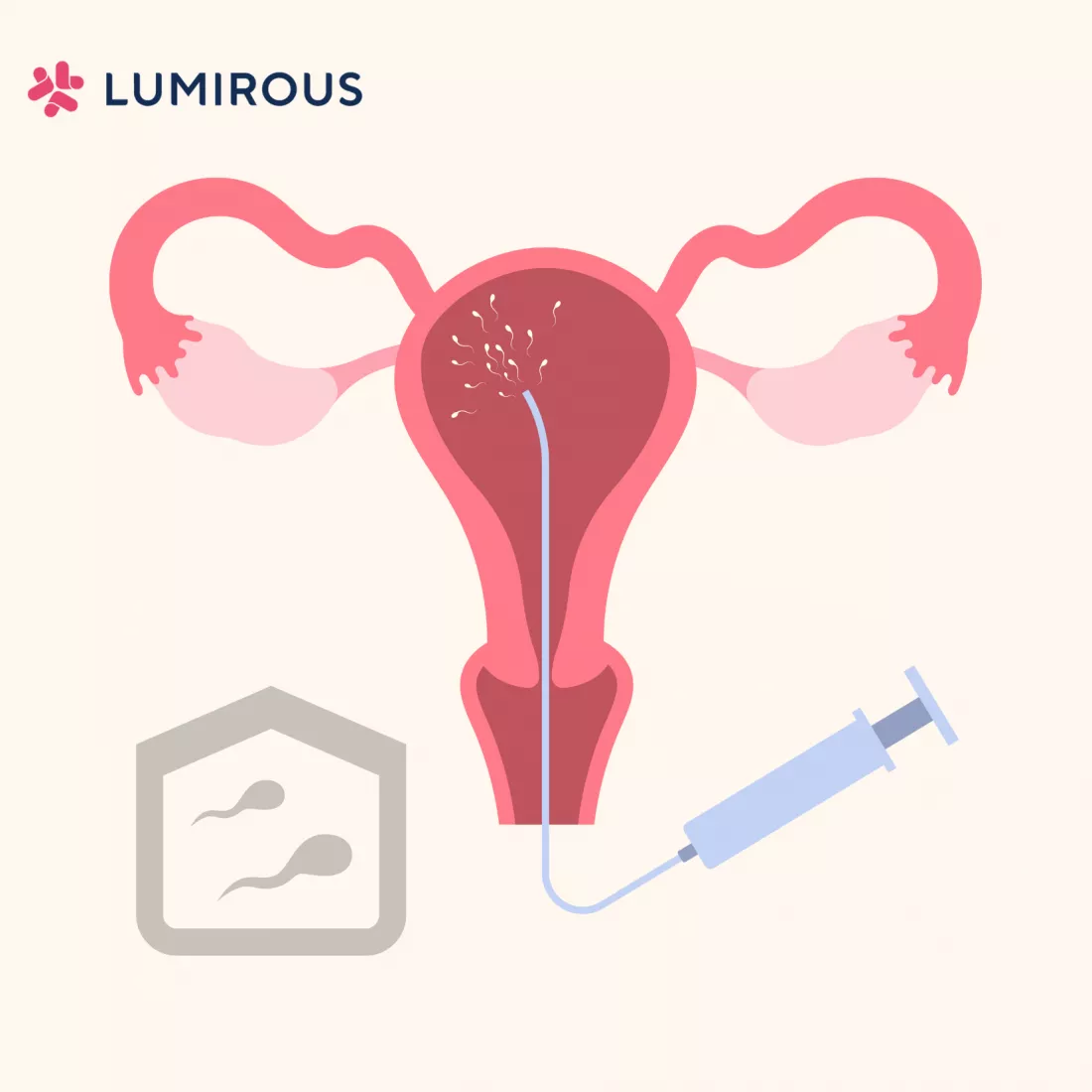The Success Rates of Insemination for Women Over 35