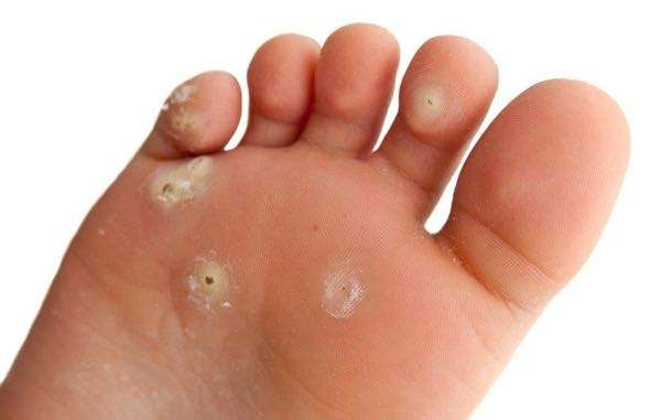 Understanding the Recurrence of Plantar Warts